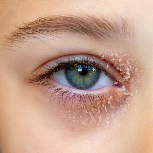 treatments for eye eczema